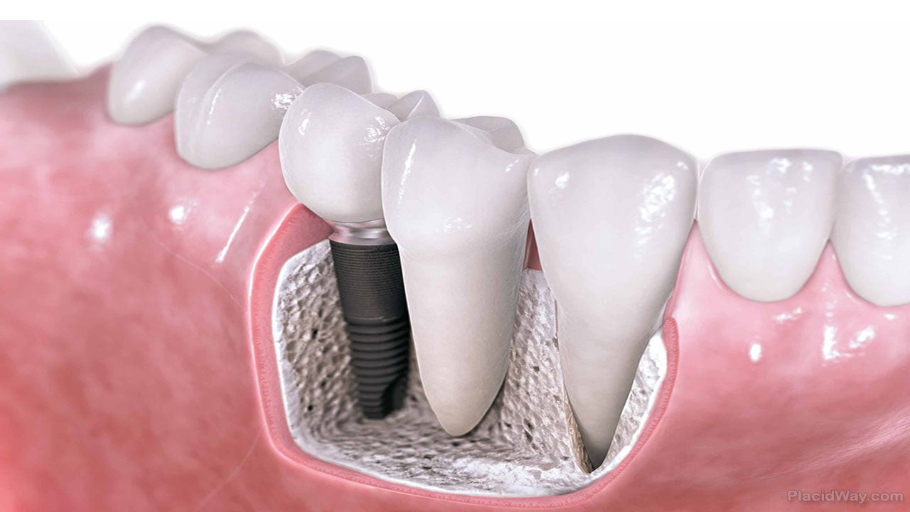 Dental Implants Durban North